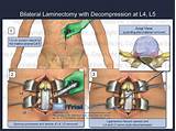 Lumbar Laminotomy Recovery Time Photos