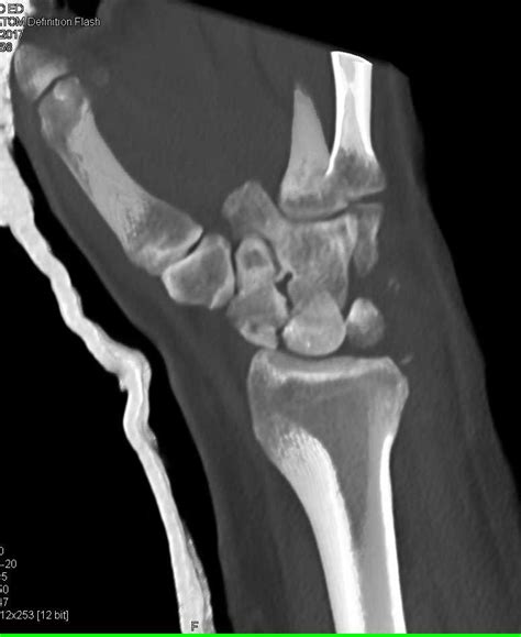 Fracturedislocation Of The Carpal Bones Musculoskeletal Case Studies