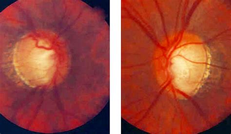 Glaucoma Tests and Diagnosis - Glaucoma Associates of Texas
