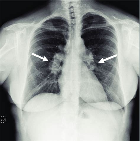 Chest X Ray Showed Bilateral Hilar Lymphadenopathies Arrows