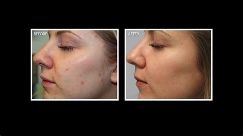 Laser Acne Treatment With Bbl Microlaser Peel Youtube