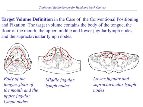 Radiation Therapy Neck Lymph Nodes All About Radiation