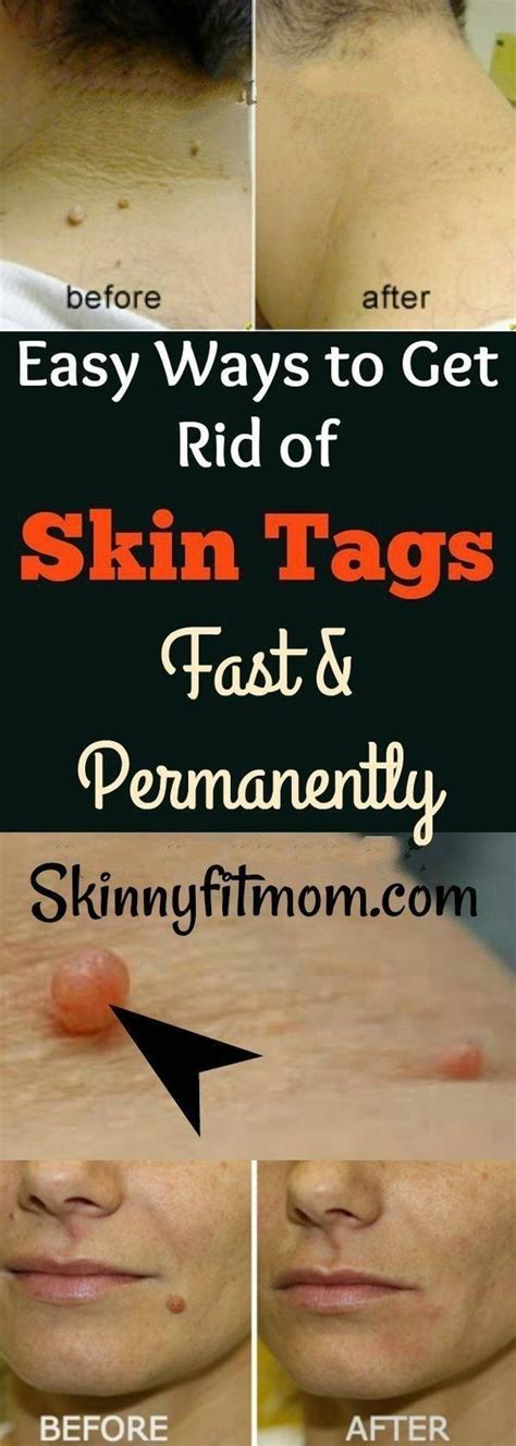 remove skin tags fast  effectively naturally