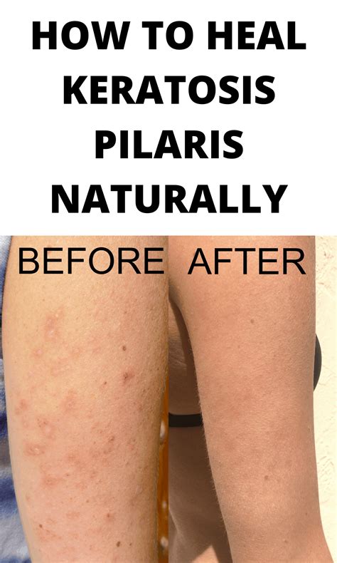 How To Heal Keratosis Pilaris Pilaris From The Inside Out Pure And Simple Nourishment