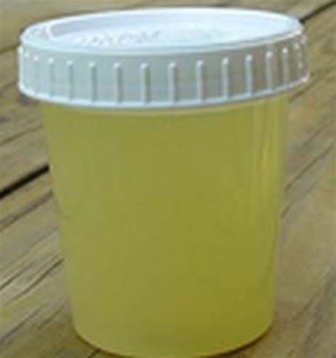 What Does Cloudy Urine Mean Hubpages