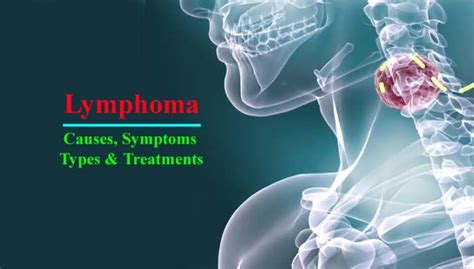Lymphoma Definition Types Causes Symptoms And Treatments Lymphoma