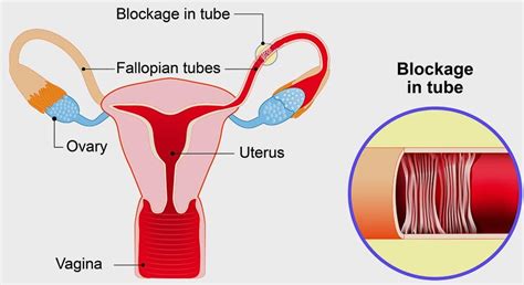 The Treatment Methods For Blocked Fallopian Tubes Mohakivf