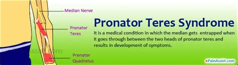 Pronator Teres Syndrome Exercises