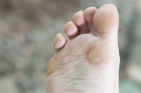 Warts Causes Types And Treatments