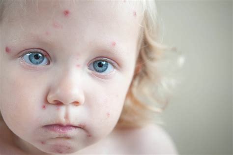 Fever With Rash In Children Should Be Taken Seriously