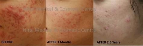 Acne Scarring Nitai Medical And Cosmetic Centre