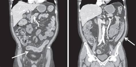 Medically Refractory Ulcerative Colitis Clinical Scenarios In Surgery