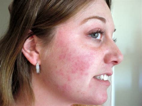 What Is Rash How To Treat Rash On Face
