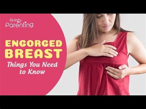 Breast Engorgement Causes Treatments And Complications Ages And Stages I Fertility Info