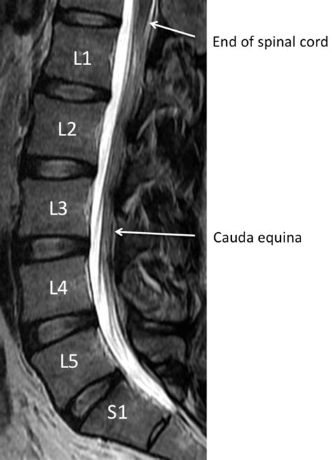 Understanding Your Mri Of The Lumbar Spine