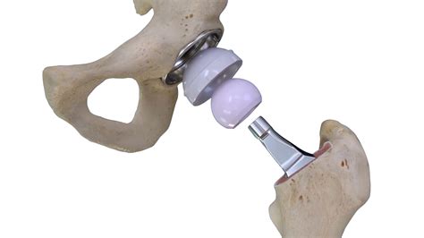 The 3d Designed Conformis Hip System Announced At The 2019 Aaos