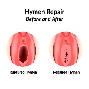 Hymen Repair