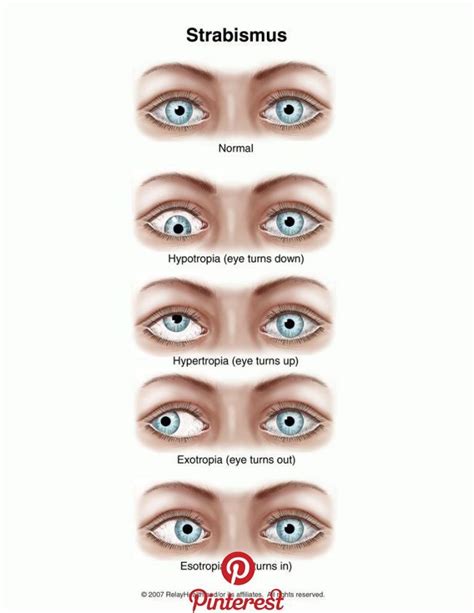 Strabismus Strabismus Is The Inward Deviation Of The Eyes Noted Before