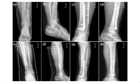 Two Cases Of Closed Distal Tibial And Fibular Fractures A D Case 1