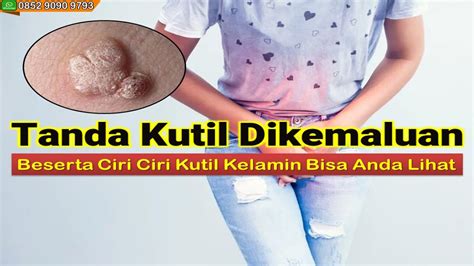 Tanda Kutil Dikemaluan Beserta Ciri Ciri Kutil Kelamin Bisa Anda Lihat