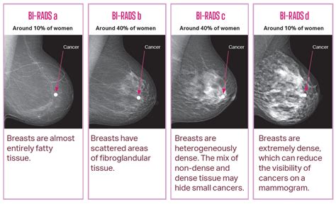 breastscreen sa breast density