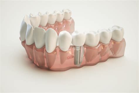 Dental Implants Are They For Everyone River Valley Smile Center