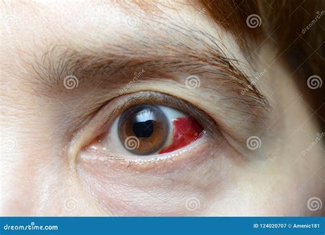 Woman With Burst Blood Vessel In Eye Stock Image Image Of Medical