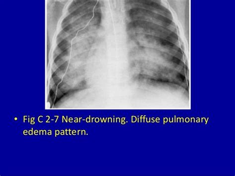 2 Pulmonary Edema Pattern Symmetric Bilateral Alveolar