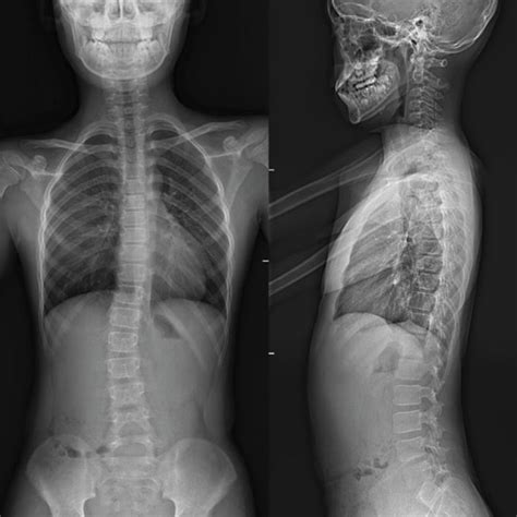 Whole Spine Plain Radiograph Ap And Lateral View At The Initial Visit