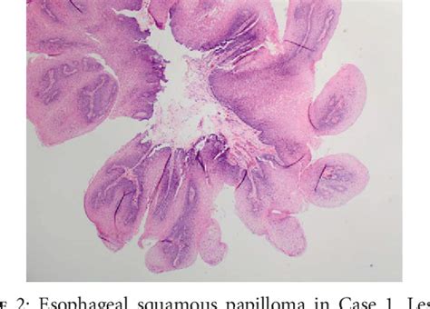 PDF Squamous Cell Papilloma Of The Esophagus A Case Series Highlighting Endoscopic And