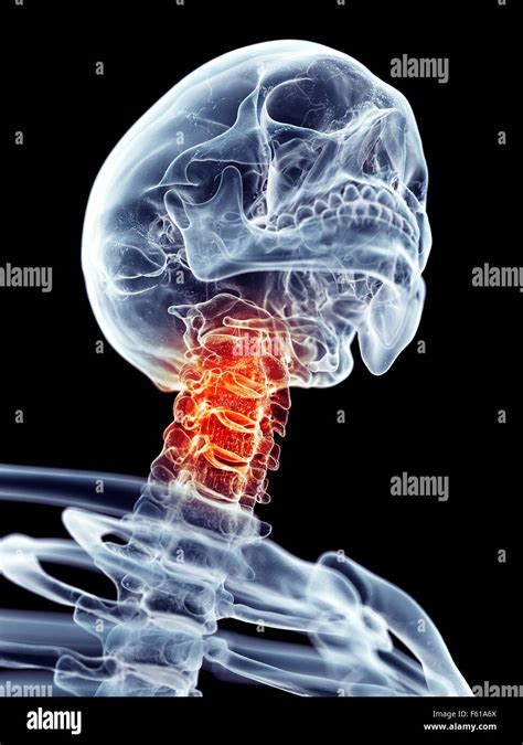 Medically Accurate Illustration Painful Cervical Spine Stock Photo
