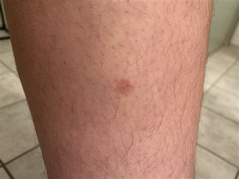 Red Round Spot On Skin Dermatologyquestions