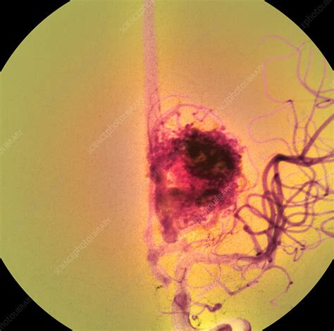 Blood Vessel Tumour Stock Image M1360115 Science Photo Library