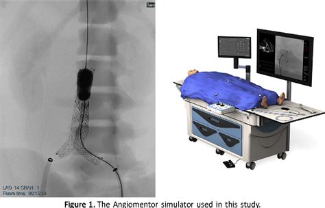 Figure 1 From Role Of Simulation In Endovascular Aneurysm Repair Evar