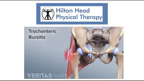 Self Treatment For Trochanteric Bursitis Hilton Head Physical Therapy YouTube