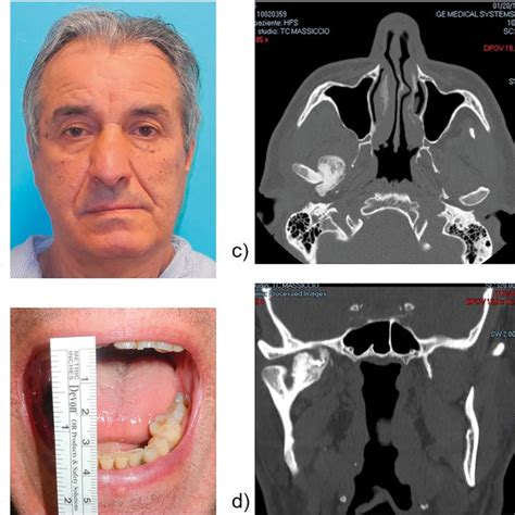 Case 7 Preoperative Frontal And Profile Views With Lip Canting