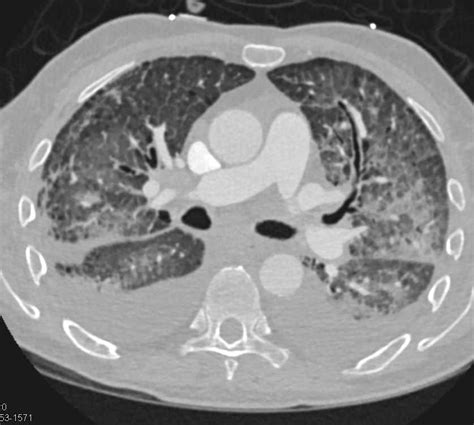 Pulmonary Edema In Patient With Interstitial Lung Disease Chest Case