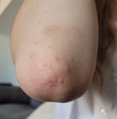 Itchy Rash But Only On Knees And Elbows Mumsnet