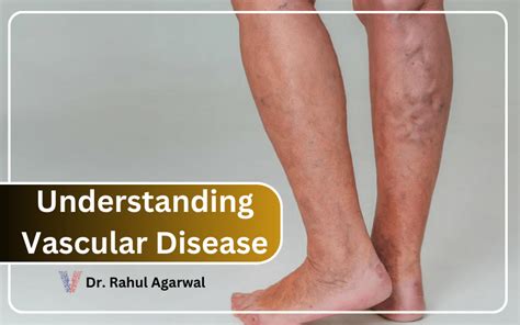 Understanding Vascular Disease Causes Symptoms And Treatment Options