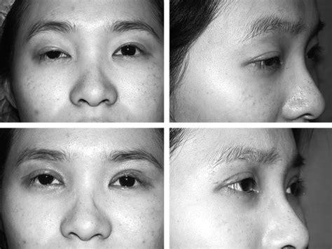 A New Trend For The Treatment Of Blepharoptosis Frontalis Orbicularis