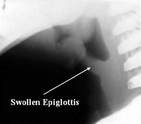 Swollen Uvula Causes Symptoms Home Remedies Treatment