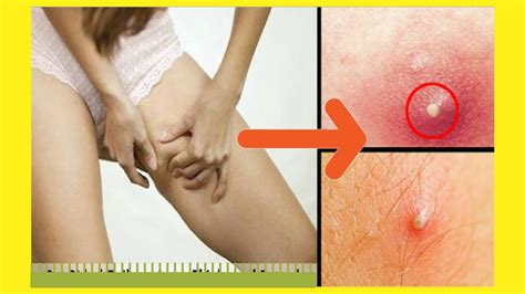 How To Get Rid Of Boils On Inner Thighs And Buttocks Get Rid Of Boils