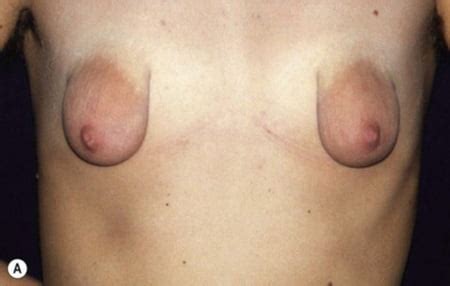 Sex Gallery Puffy And Malformed Tits Lovely Areolas Plastic Surgery