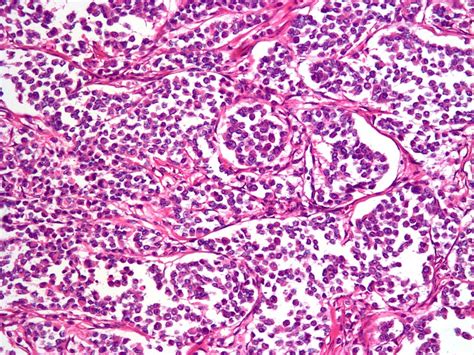 Pathology Outlines Case Of The Week 369