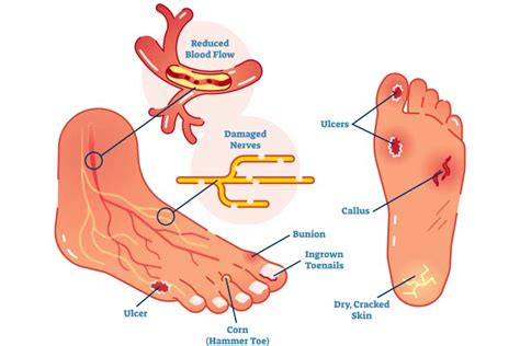 Diabetic Foot Ulcer Treatment In Thane Diabetic Care Center In Thane