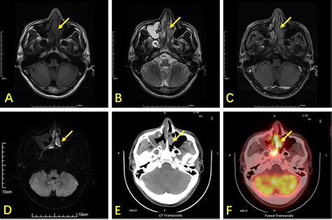 Frontiers Comparison Of Nasopharyngeal Mr 18 F Fdg Petct And 18 F