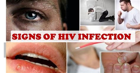 5 Common Hiv Symptoms In Men Ladies See How To Know If Hes Hiv Positive Check No 3