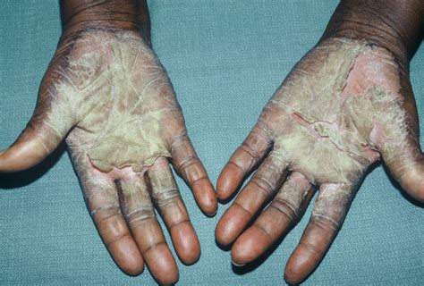 Dyshidrotic Dermatitis On Hands