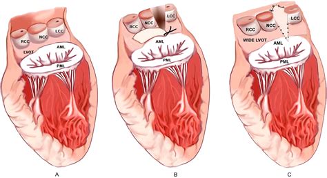 Posterior Aortic Root Enlargement During Aortic Valve Replacement Role