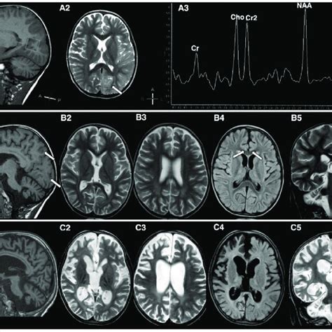 Mri Brain Imaging A Mri Abnormalities In The Acute Stage 48 H From
